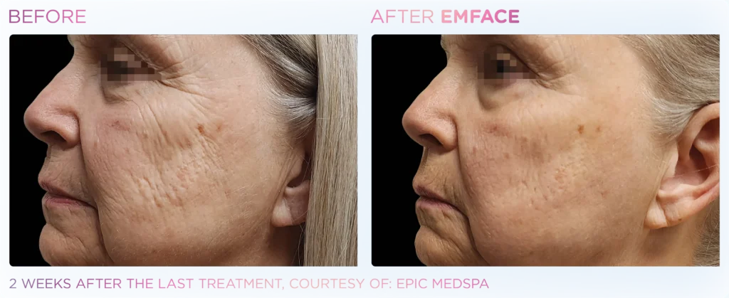 Emface hanover york pa